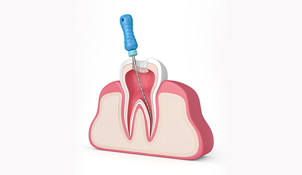根管治療とは？