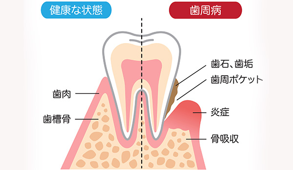 そもそも歯周病とは？