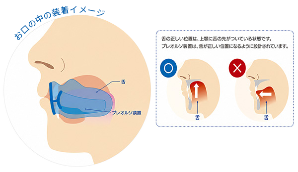プレオルソの4つの特徴